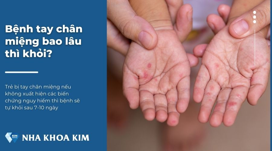 Trẻ bị tay chân miệng bao lâu thì khỏi?