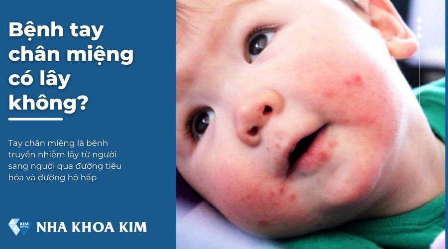 Bệnh tay chân miệng có lây không?