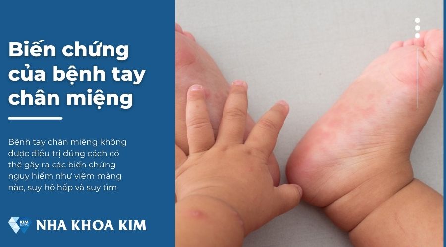 Biến chứng của bệnh tay chân miệng