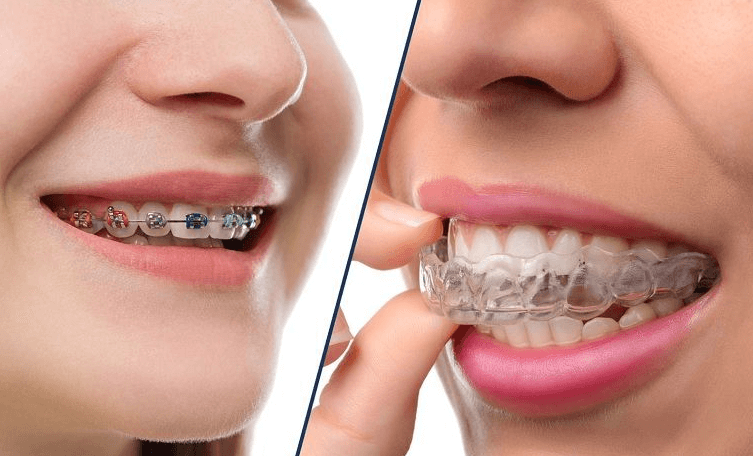 Một số loại niềng răng phổ biến nhất hiện nay