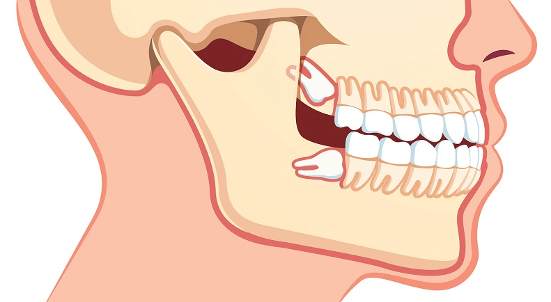 Tại sao răng khôn mọc lại bị đau?