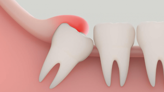 Mách bạn cách giảm đau khi mọc răng khôn nhanh nhất tại nhà