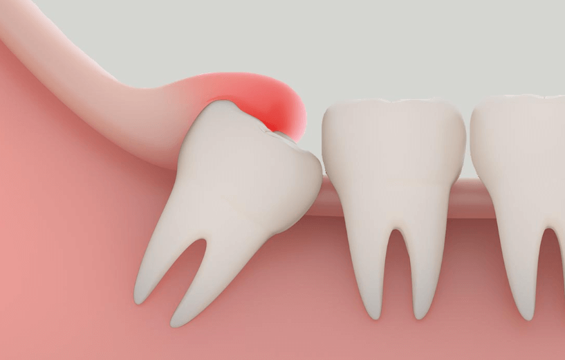 Mọc răng khôn bao lâu thì mới hết đau?
