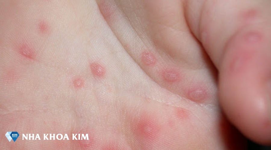 hình ảnh bệnh tay chân miệng cấp độ 1