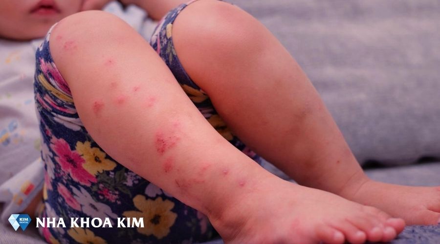 hình ảnh trẻ bị bệnh tay chân miệng