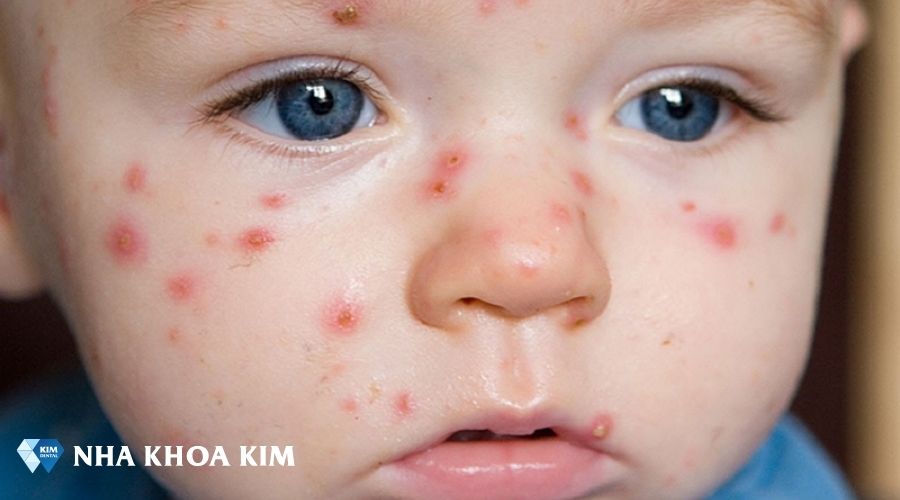 Hình ảnh bệnh tay chân miệng ở trẻ nhỏ