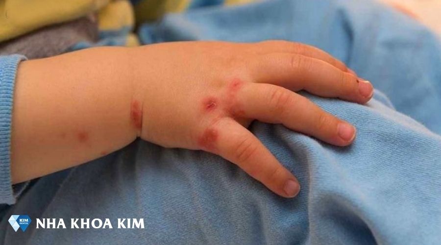 Hình ảnh nốt tay chân miệng ở trẻ