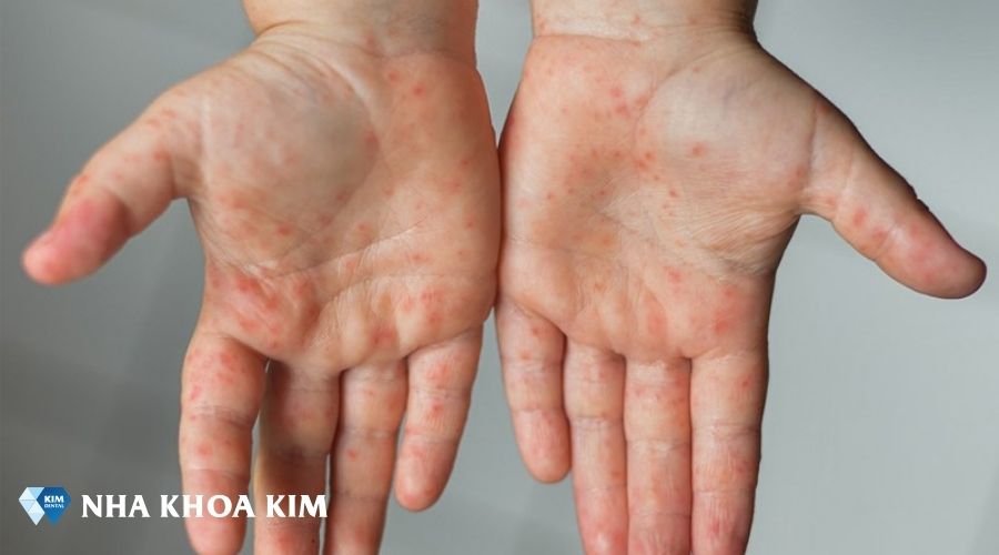 hình ảnh trẻ bị tay chân miệng
