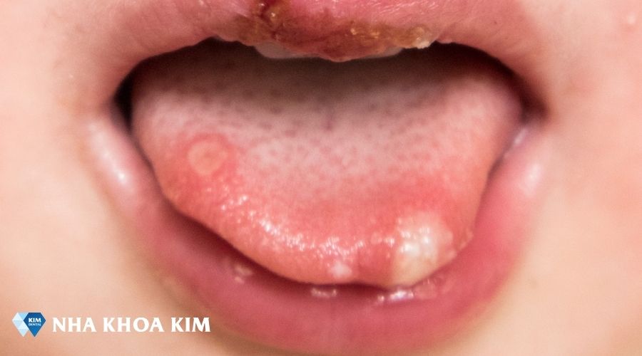 Hình ảnh bệnh tay chân miệng ở giai đoạn nặng