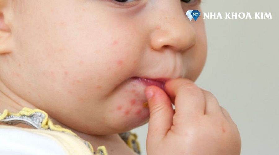 Hình ảnh mụn tay chân miệng ở trẻ