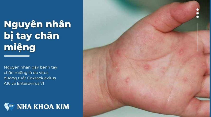 Nguyên nhân bị tay chân miệng là gì?