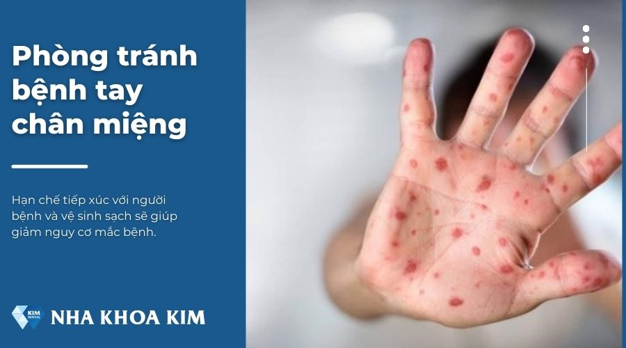 Cách phòng tránh bệnh tay chân miệng