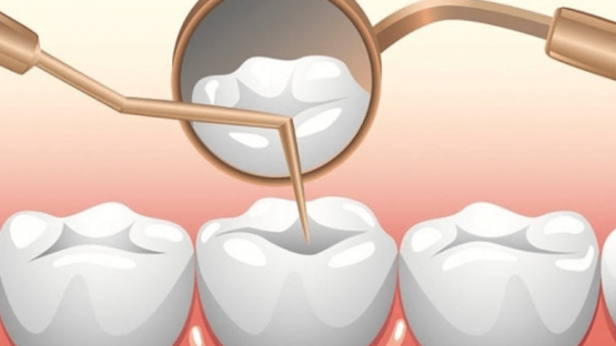 Tủy răng là gì? Chức năng và một số bệnh lý về tủy răng