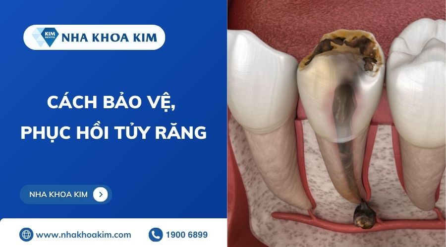 cách bảo vệ phục hồi tủy răng