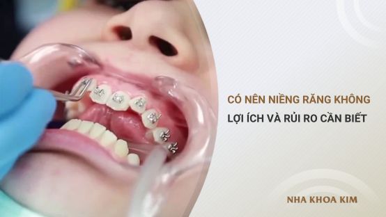 Có nên niềng răng không? Tìm hiểu lợi ích, tác hại khi niềng răng
