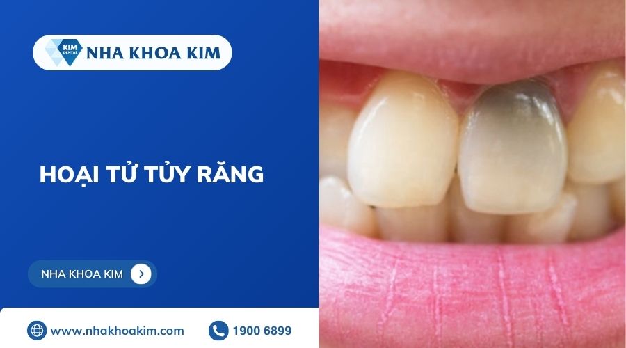 hoại tử tủy răng