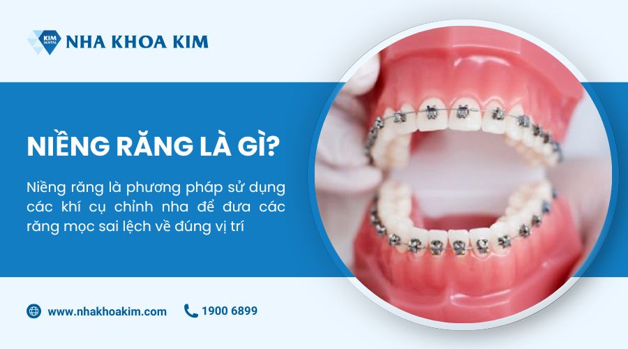niềng răng là gì