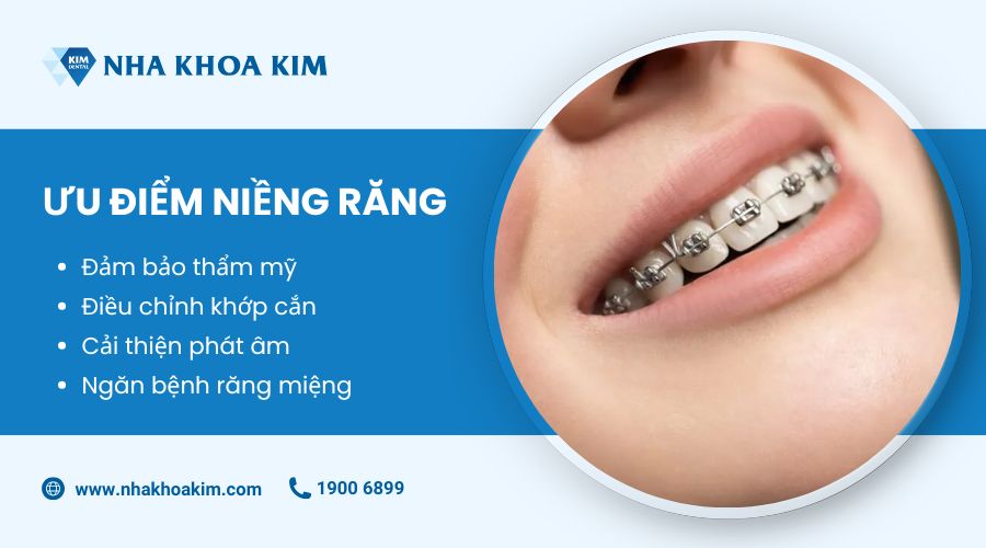 ưu điểm của niềng răng
