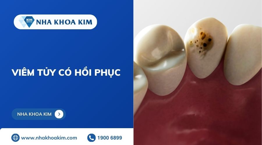 viêm tủy răng có hồi phục