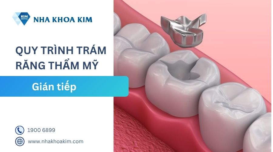 quy trình trám răng gián tiếp
