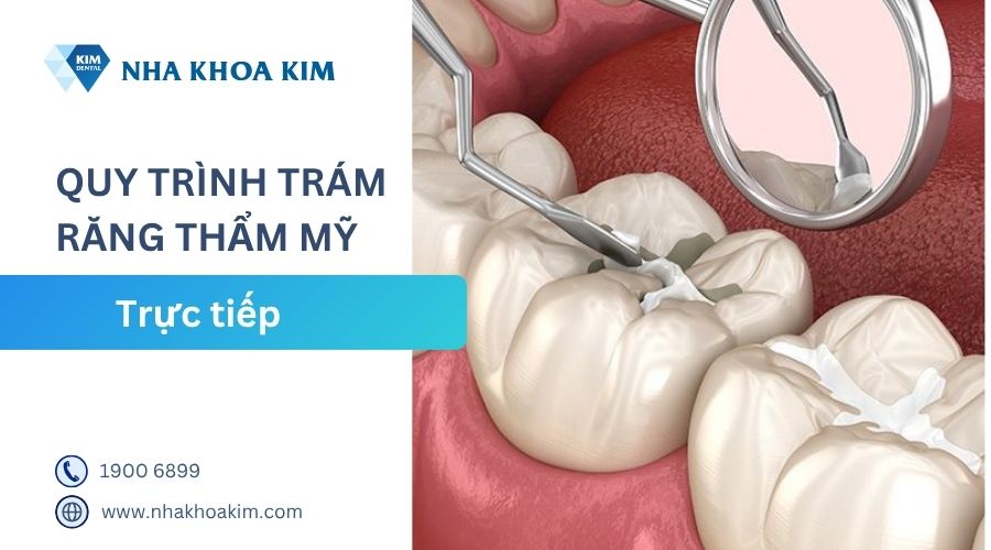 quy trình trám răng trực tiếp
