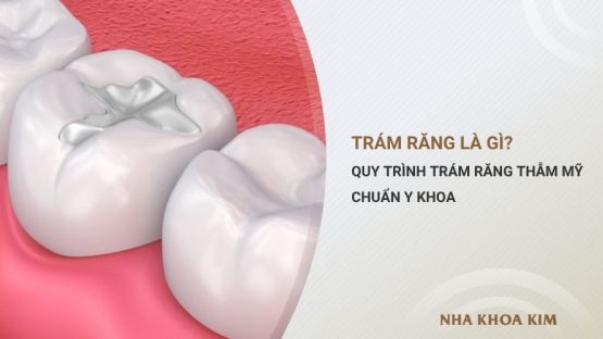 Trám răng là gì? Quy trình trám răng thẫm mỹ chuẩn y khoa