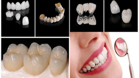 Răng sứ Titan là gì? Răng sứ kim loại Titan có tốt không?