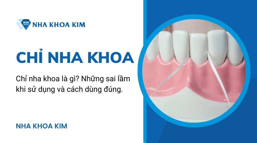 Chỉ nha khoa là gì?