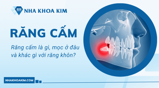 Răng cấm là gì, mọc ở đâu và khác gì với răng khôn