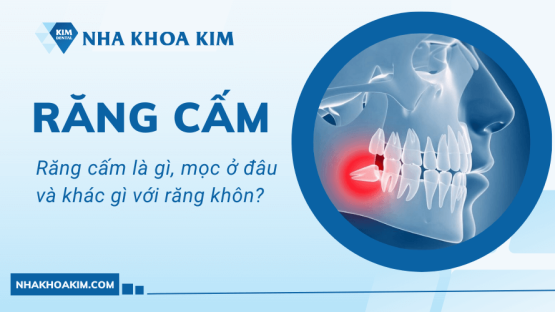 Răng cấm là gì, mọc ở đâu và khác gì với răng khôn