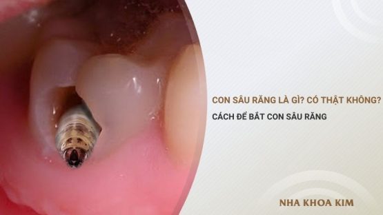 Con sâu răng là gì? Có thật không? Cách để bắt con sâu răng