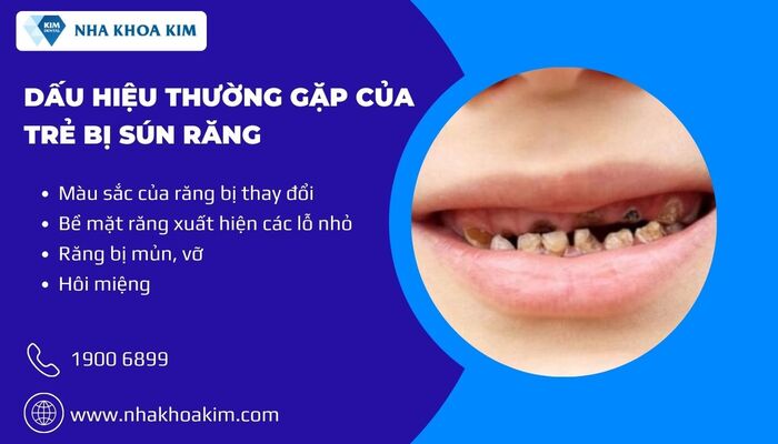 dấu hiệu nhận biết sún miệng 