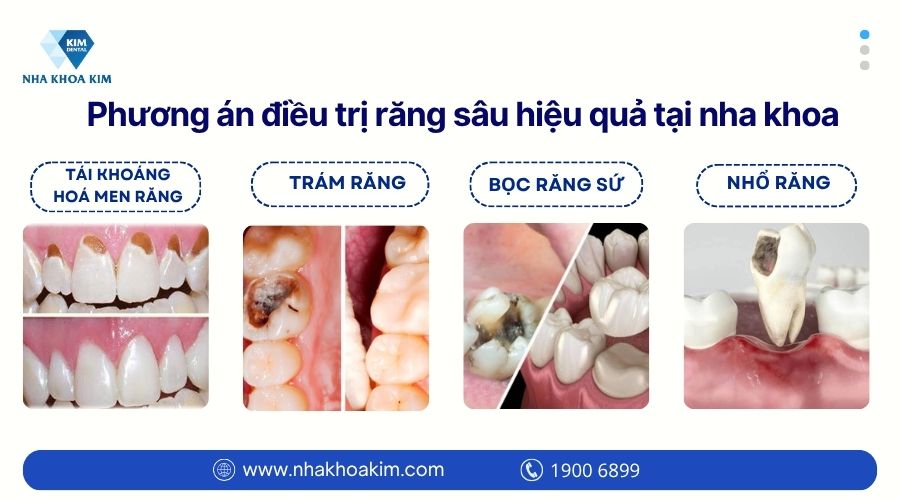 Phương án điều trị răng sâu hiệu quả tại nha khoa