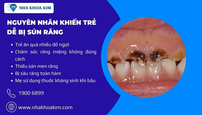 Nguyên nhân bé bị sún