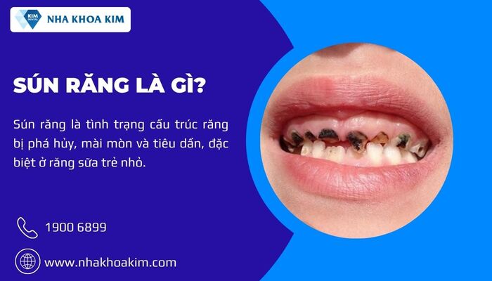 sún răng là gì