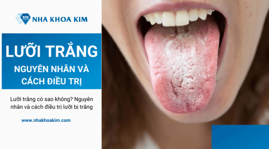 Lưỡi trắng là bệnh gì? Nguyên nhân và cách điều trị lưỡi trắng