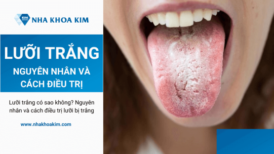 Lưỡi trắng là bệnh gì? Nguyên nhân và cách điều trị lưỡi trắng