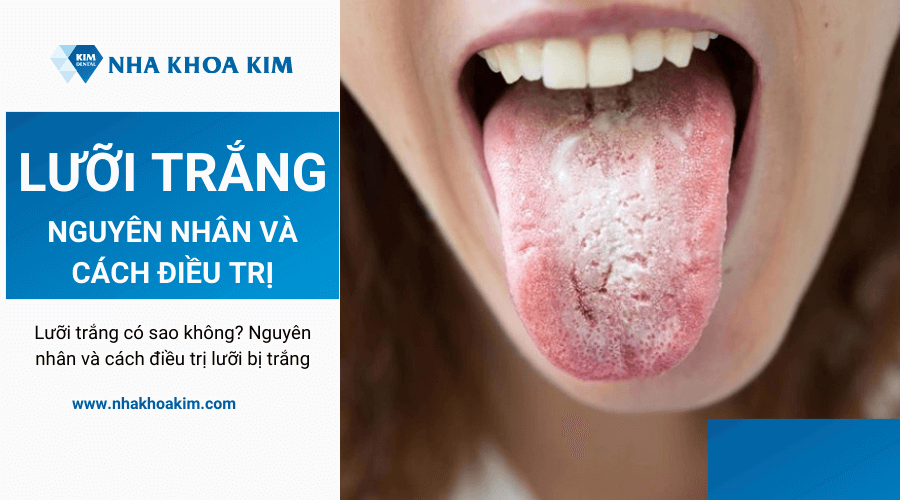 Lưỡi trắng kèm theo mùi hôi miệng là dấu hiệu của bệnh gì?
