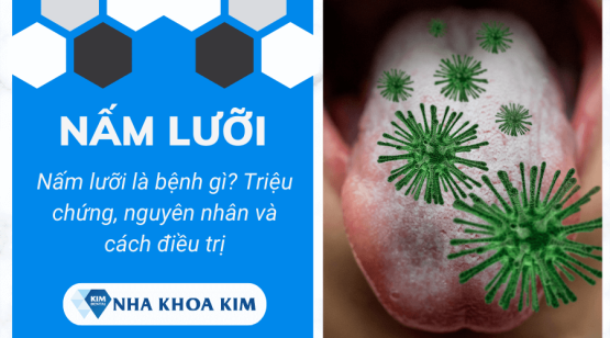 Nấm lưỡi là bệnh gì? Triệu chứng, nguyên nhân và cách điều trị