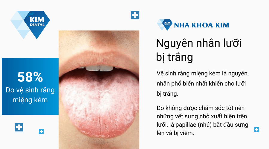 Lưỡi Bị Trắng Là Bị Bệnh Gì? Nguyên Nhân, Triệu Chứng và Cách Điều Trị Hiệu Quả