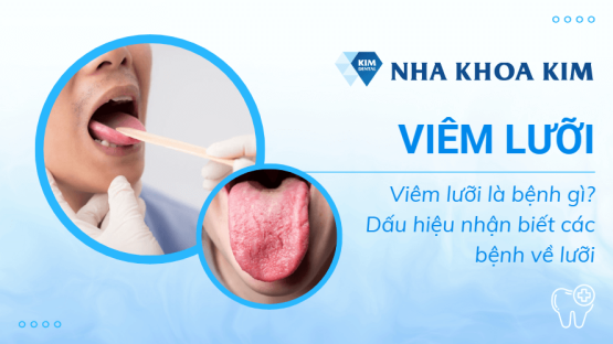 Viêm lưỡi là bệnh gì? Dấu hiệu nhận biết các bệnh về lưỡi