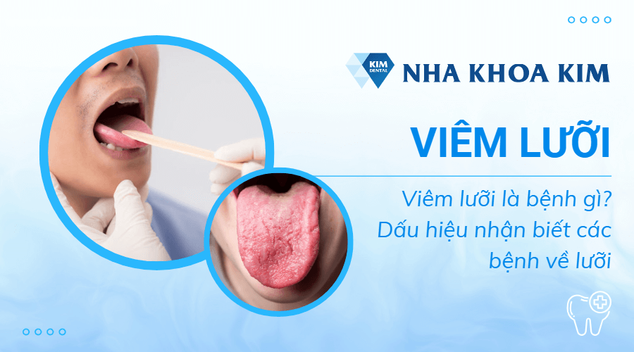 Viêm lưỡi có thể gắn kết với những biểu hiện của bệnh lý khác không?
