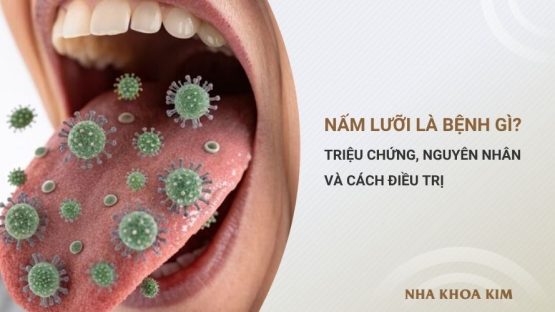 Nấm lưỡi là bệnh gì? Triệu chứng, nguyên nhân và cách điều trị