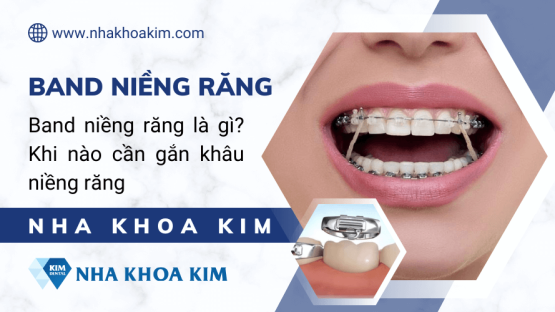 Band niềng răng là gì? Gắn Band niềng răng khi nào?