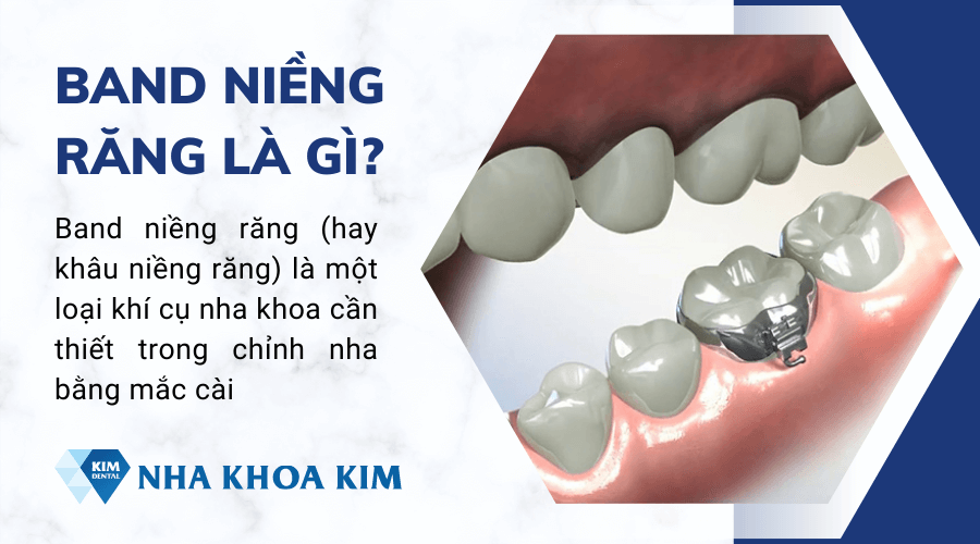 Band niềng răng là gì?