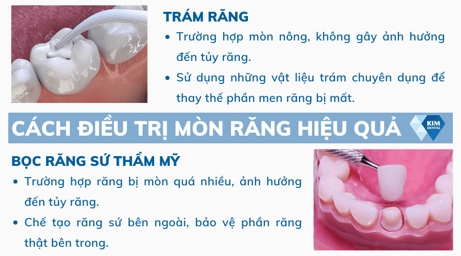 Cách điều trị mòn răng hiệu quả