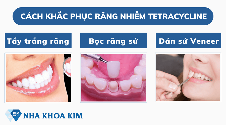 Cách khắc phục răng nhiễm Tetracycline