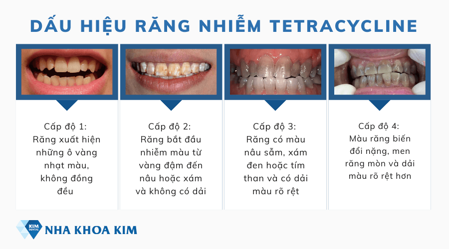 Dấu hiệu nhận biết răng nhiễm Tetracycline