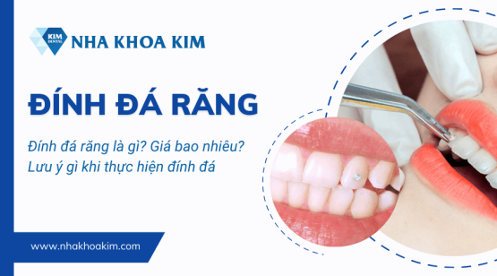 Đính đá răng là gì? Giá bao nhiêu? Lưu ý gì khi thực hiện đính đá