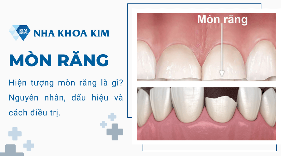 Mòn răng là gì? Nguyên nhân, dấu hiệu và cách điều trị